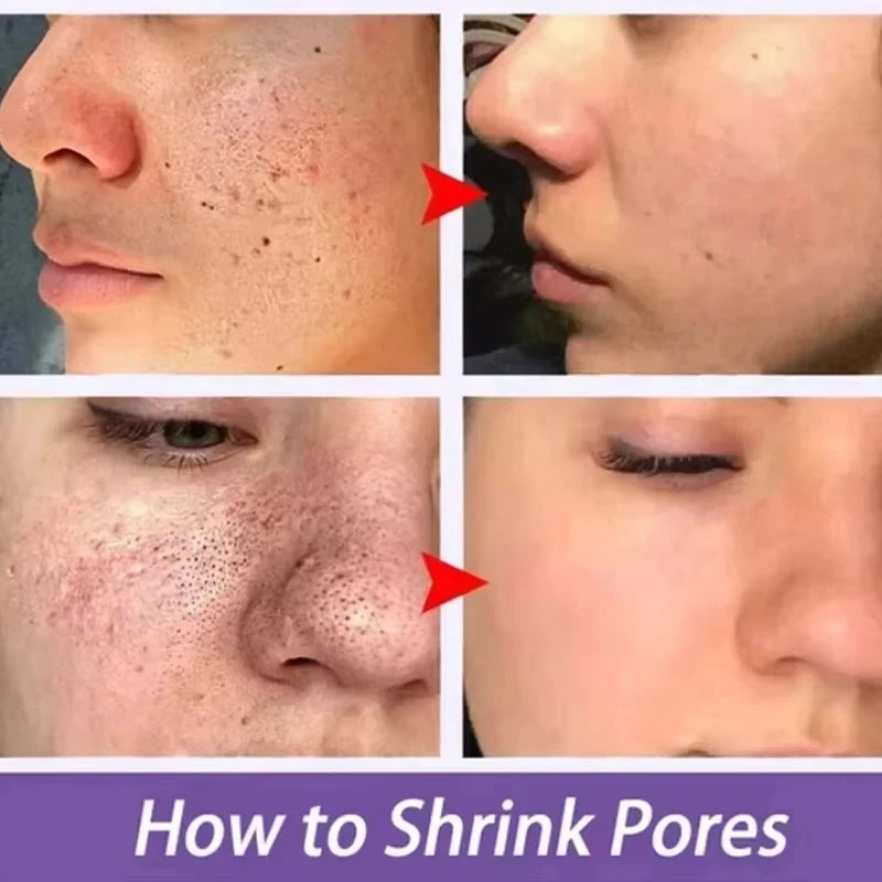 Remove Large Pores Serum Lactic Acid Facial Pore Shrinking Repairing Products Pore Minimizing Firming Smooth Korean Skin Care.